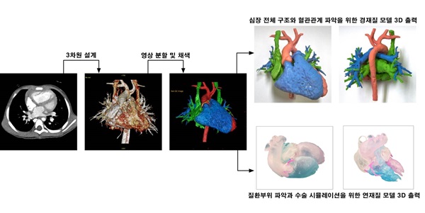 3D프린팅 심장기형질환 수술 시뮬레이션