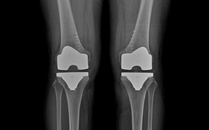 무릎 인공관절 수술 X-ray
