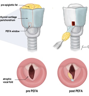 자가지방 피판 성대 재건술(PEFA, Autologous Pedicled Fat Flap) 모식도