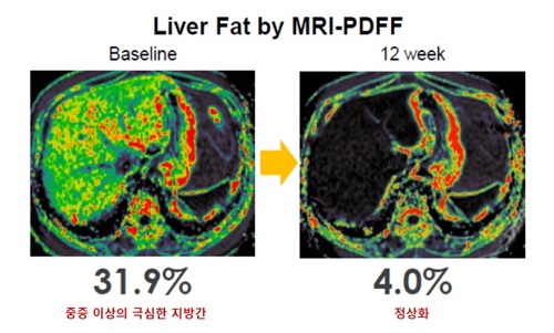 MRI-PDFF 검사로 확인한 지방간 감소 효과