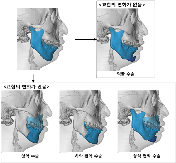 골격성 2급 부정교합(무턱)의 다양한 수술방법