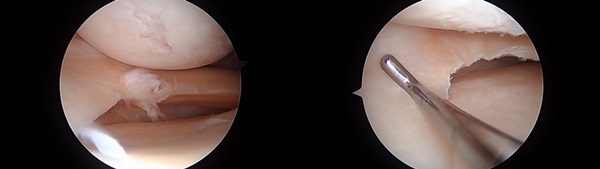 연골판부분절제술 전(왼쪽)과 후(오른쪽)