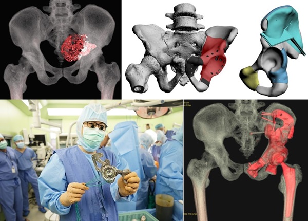 3D프린팅 맞춤형 임플란트를 이용한 골반골 재건 수술