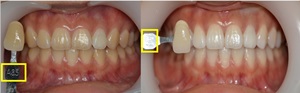 치아미백술 전(좌측)-후(우측) 사진. A3.5색상에서 A1색상으로 바뀐 것을 확인할 수 있다.(노란색 네모 참조)