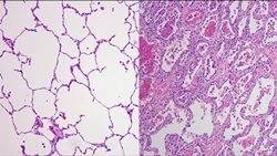 폐 현미경 사진 왼쪽 정상, 오른쪽 코로나19 환자