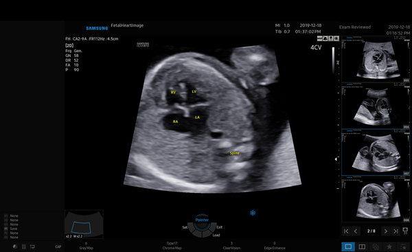 하트어시스트 실행 시 태아 심장 초음파 화면에서 자동으로 심장을 인식하고 주석을 표시한 화면