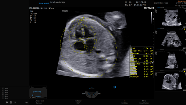 하트어시스트 실행 시 태아 심장 초음파 화면에서 자동으로 심장을 인식하고 측정값을 표시한 화면