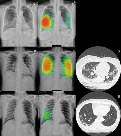 루닛 인사이트 CXR를 활용해 코로나19 폐렴이 표시되는 흉부 엑스레이 이미지