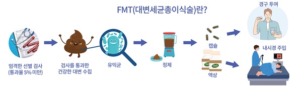 FMT(대변세균총이식술) 그림설명(체크앤케어 제공)