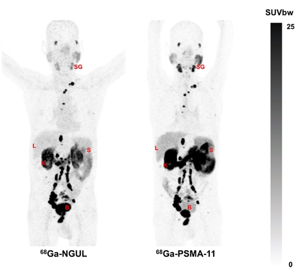 좌측 PSMA-NGUL의 경우 전립선암의 원발병소 (전립선), 임파절 전이병소, 뼈전이 병소가 뚜렷하고, 다른 장기들이 훨씬 흐리게 보여 보다 명확하게 진단할 수 있다.
