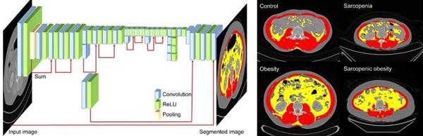 왼쪽) CT영상에서 인공지능을 이용해 몸의 체성분을 분류하는 과정, 오른쪽) 체성분에 따라 정상, 비만, 근감소증, 근감소성 비만의 대표적인 CT영상을 근육과 내장지방으로 구분한 이미지(빨간부분:근육, 노란부분:내장지방)
