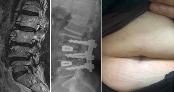 3년 동안 허리 통증 및 다리 방사통을 겪은 환자(72세, 여성) ‘배꼽경유 척추유합술’ 성공 사례 - 왼쪽부터, 수술 전 MRI영상, 수술 후 X-ray 사진, 수술 6개월 후 흉터가 거의 없는 수술부위