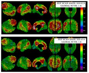 뇌혈관장벽 개방술 전(위), 후(아래) 아밀로이드 PET 검사 결과, 후 사진에서 아밀로이드 양과 범위(회색+빨간색)가 감소한 것을 확인할 수 있다.