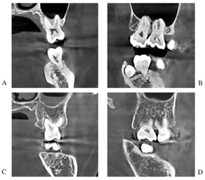 치아 뿌리가 상악동 동굴 내부로 들어간 CBCT 사진 (A,B), 상악동 동굴 내부로 들어가지 않은 CBCT 사진 (C,D)A,C는 관상면(신체를 앞뒤로 나누는 가상의 면) B,D는 시상면(신체를 좌우로 나누는 가상의 면)