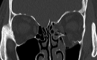 증상은 없지만 안와뼈 골절 범위가 매우 넓은 환자의 CT 영상 이미지