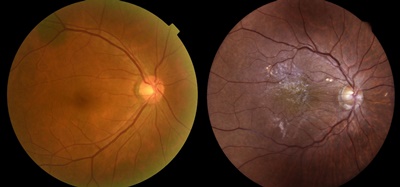 정상(좌)과 망막앞막 환자(우)의 안저사진. 황반부에 하얀 반투명막과 이로 인한 망막전층의 주름 및 혈관 변형이 관찰된다.