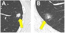 (A)순수 고형(pure solid)으로 보이는 종양과 (B)간유리 음영(ground glass opacity)을 포함한 종양의 CT 이미지