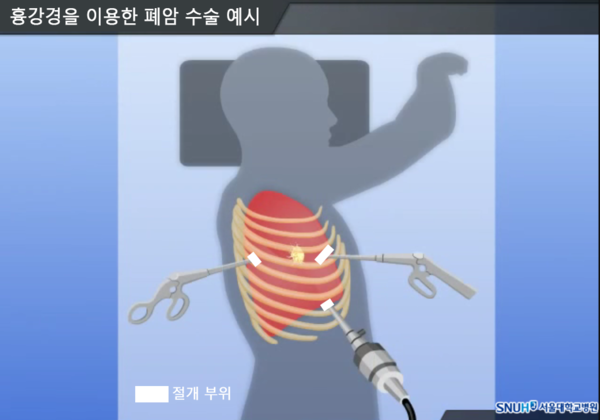 흉강경을 이용한 폐암 수술 예시 (출처: 서울대병원 암정보교육센터)